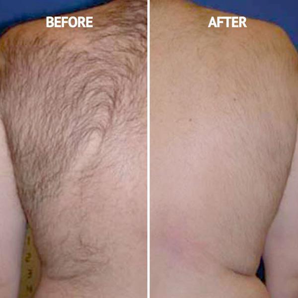 Back Hair Removal And Body Shaver