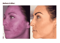 Thumbnail for -in- Skin Mesotherapy Treatment Device PeekWise