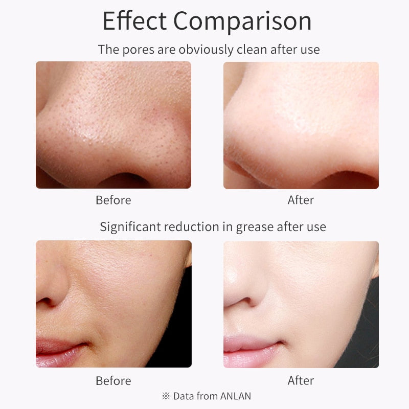 ALN™ - Ultrasonic Skin Scrubber and Tightener