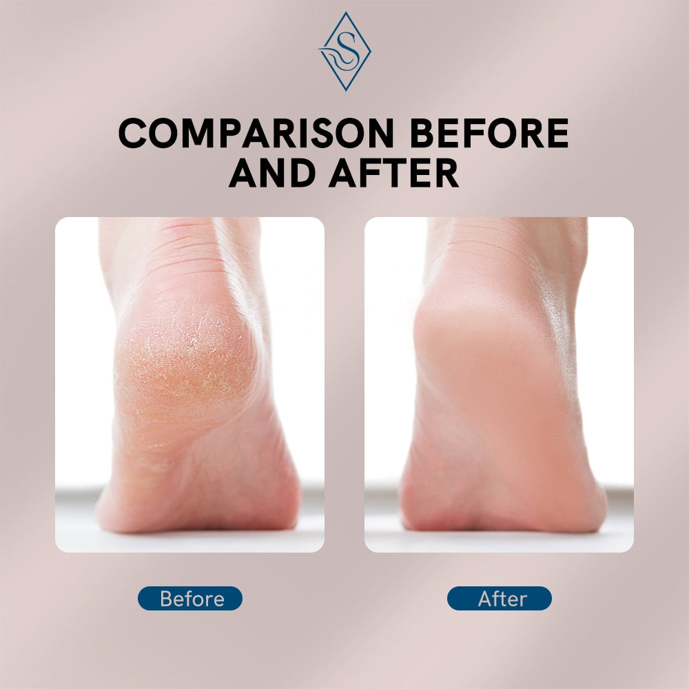 Electric Foot Callus Remover