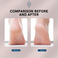 Thumbnail for Electric Foot Callus Remover